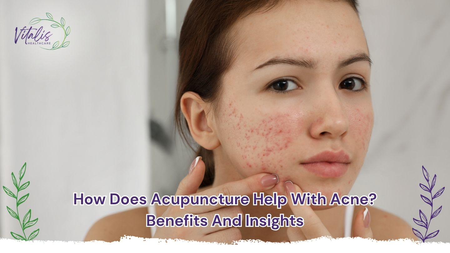 How Does Acupuncture Help With Acne? Benefits and Insights